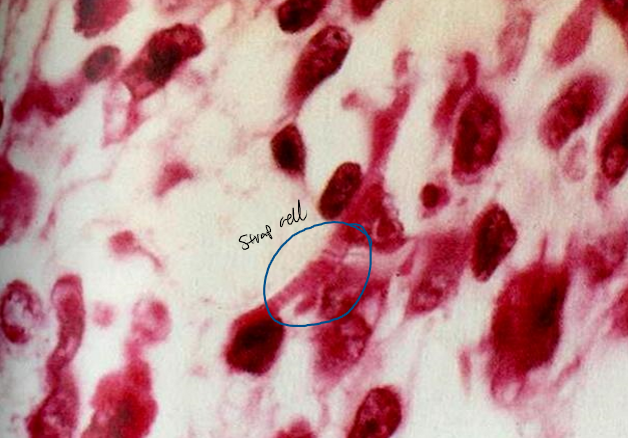 <p>rhabdomyosarcoma that include <strong><mark data-color="blue">cambium layer with primitive around cells, oval cells, strap cells, &amp; racquet-shaped cells </mark></strong></p><ul><li><p><strong><mark data-color="red">sarcoma botryoides - variant which presents as grape-like mass</mark></strong></p></li></ul>