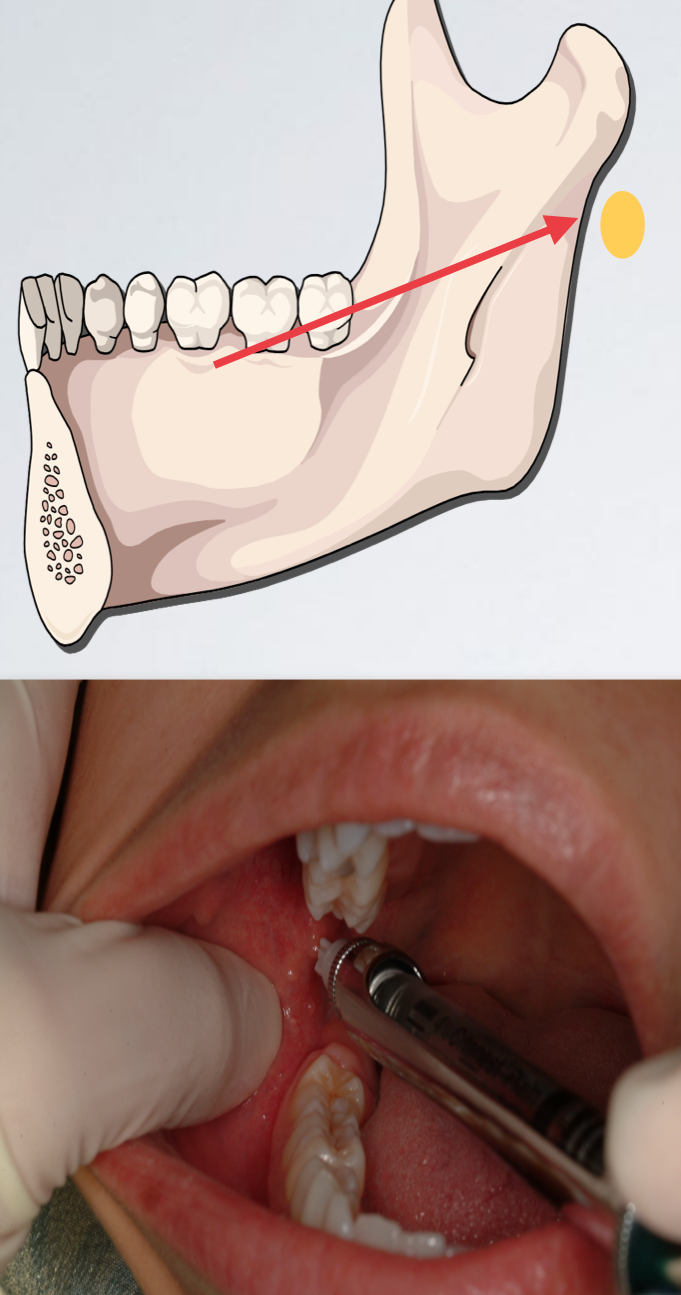 <p>which IAN standard/halstead issue?</p><ul><li><p>Needle tip located too posteriorly</p></li><li><p>Withdraw slightly</p></li><li><p>Angulate the needle tip more anteriorly (syringe barrel more posteriorly)</p></li><li><p>Re-advance to correct depth (20-25 mm)</p></li></ul><p></p>