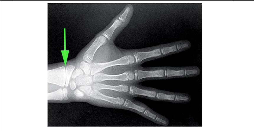 <p>What is the growth plate in a child’s hand called, as marked by the green arrow?</p>