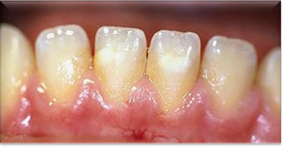 <p>What causes Yellow extrinsic stain?</p>