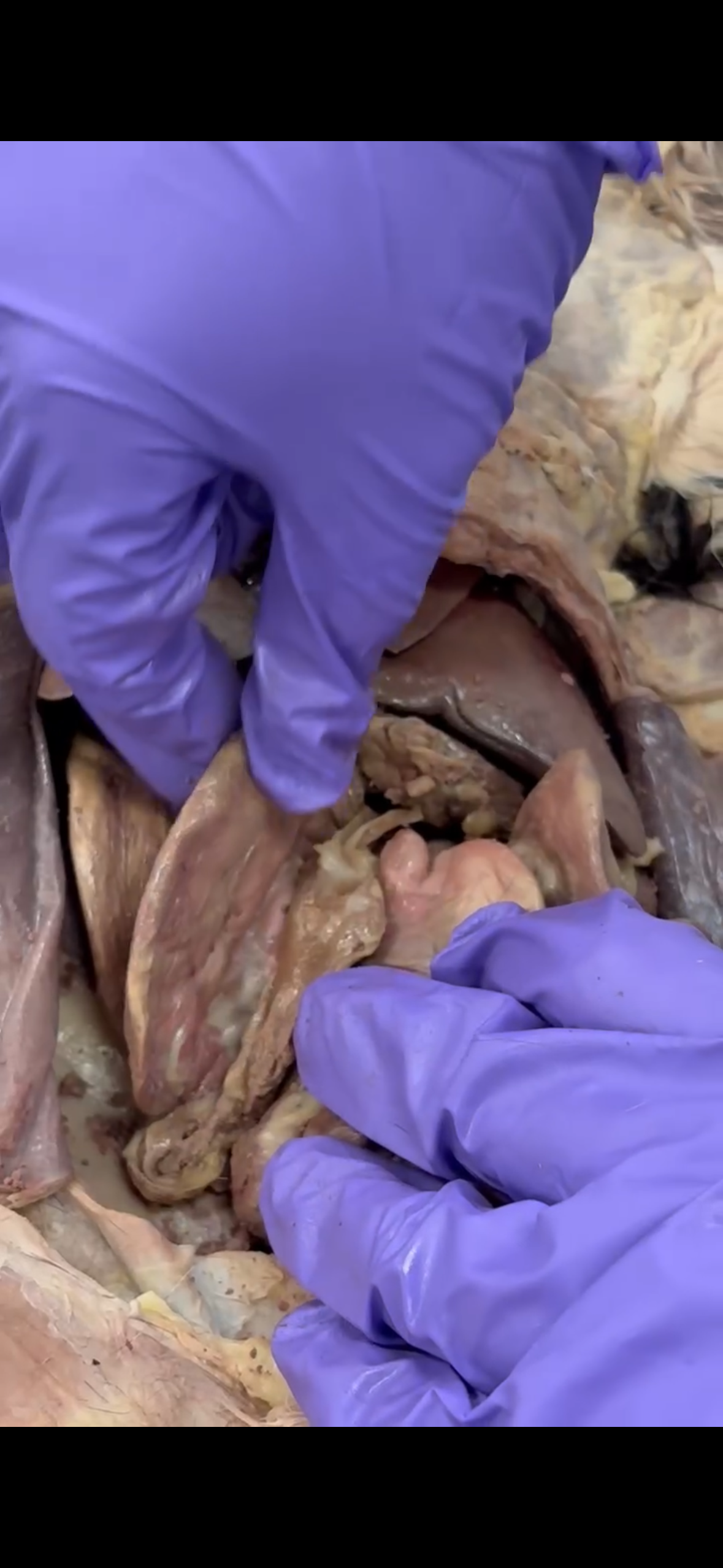 <p>What part is pinched</p>