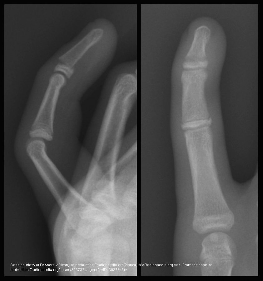 <p>A transverse fracture through the growth plate with complete separation of the epiphysis.</p>