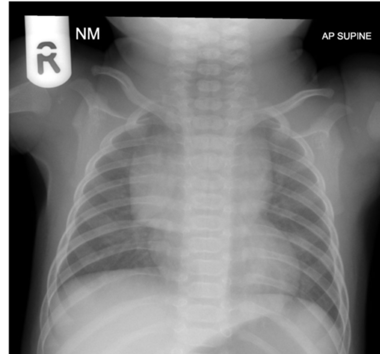 <p>this patient, age 2, is showing what?</p>