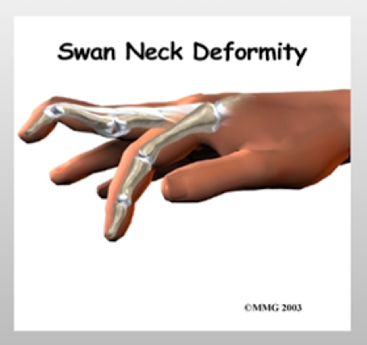 <p>PIP joint will be HYPEREXTENDED</p><p>DIP joint will be FLEXED</p>