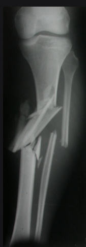 <p>What kinds of treatments would be recommended for this fracture</p>