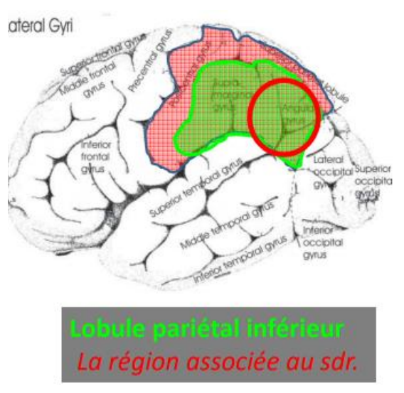 Lésion du lobe pariétal gauche, gyrus angulaire qui donne une tétrade de symptômes :
• Acalculie (opération arithmétique comme 100-7 ; 57+29 ; 7x9). Faire le calcul ou reprendre en mémoire.
• Dysgraphie périphérique et spatiale, Périphérique et spatiale, affectant la copie (lecture et dénomination OK). Ecriture irrégulière.
• Agnosie digitale (« Quel est ce doigt ? Bougez l’index. Bougez le même doigt à l’autre main »).
• Désorientation gauche/droite : sur soi-même, sur autrui, montrez-moi votre main gauche, votre genou droit,… → demander sur soi est plus complexe car le patient doit faire une rotation mentale.