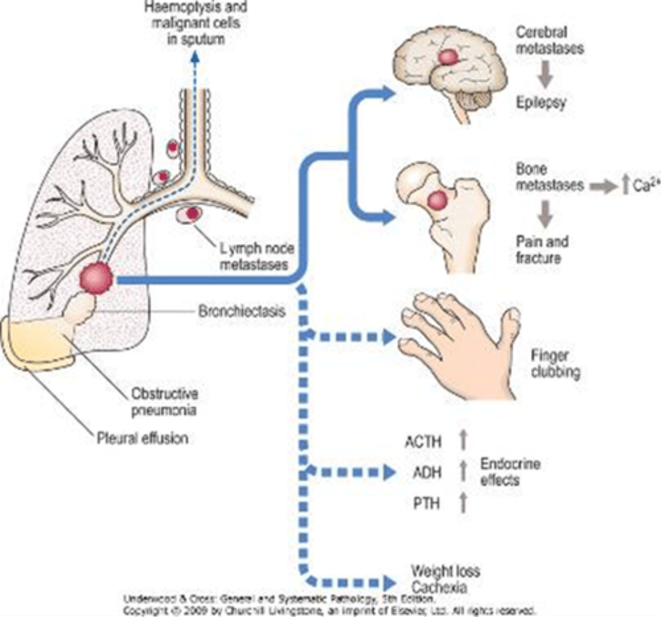 <p>XS mineralocorticoid: Conn's syndrome.</p><p>XS glucocorticoids: Cushing's syndrome.</p><p>Malignant tumour: All 3 in XS.</p><p>Ectopic ACTH syndrome from neuroendocrine lung tumour (small cell carcinoma): due to XS glucocorticoids. </p>