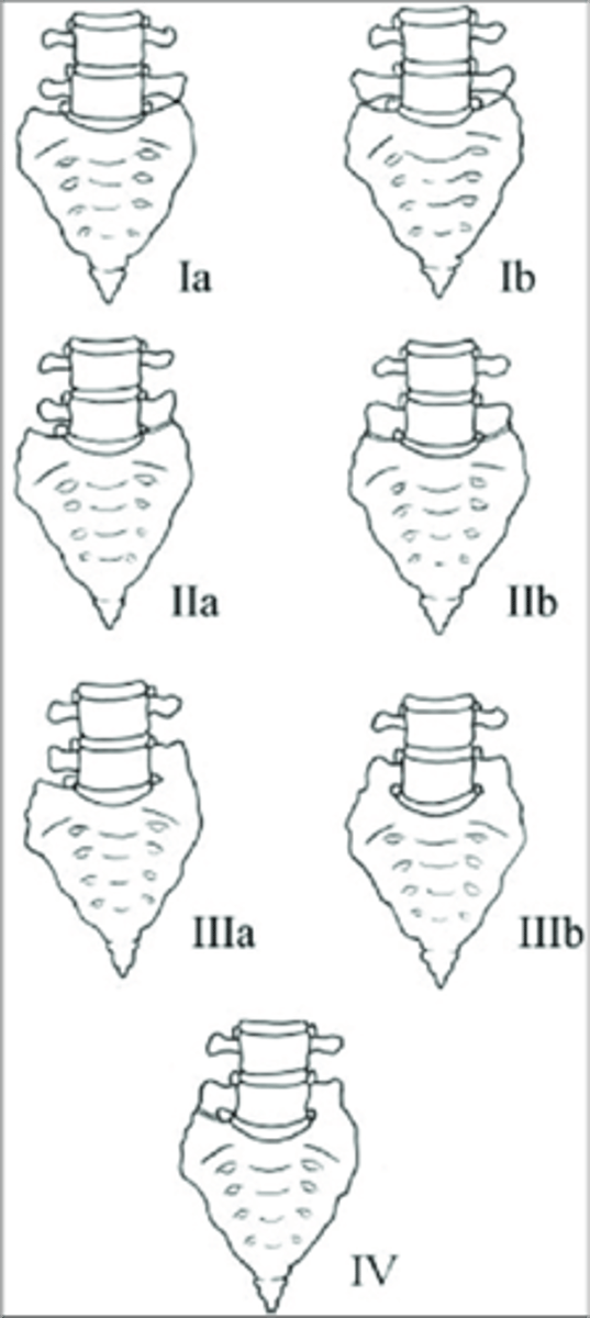 <p>Lumbosacral Transitional Segments result in a _____ disc space</p>