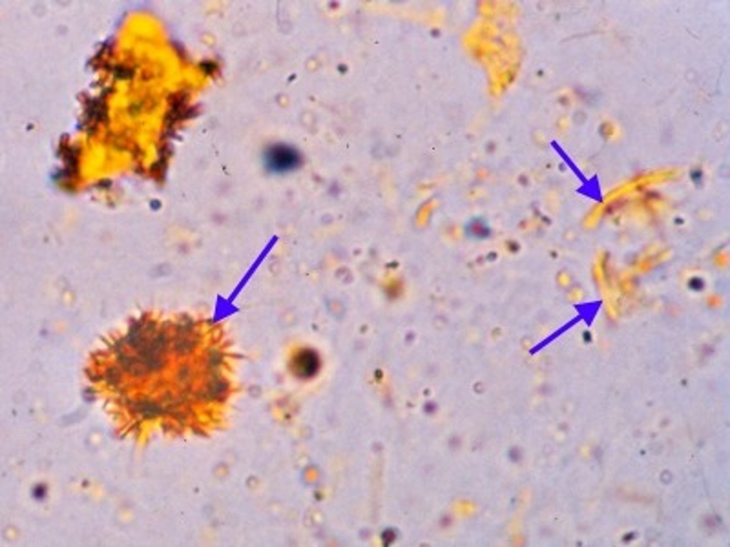 <p>seen in the urine when the serum bilirubin level increases. The macroscopic appearance of urine with bilirubin crystals is orange to almost black. The crystals themselves appear as gold-orange needle-like forms that are sometimes clumped together.</p>