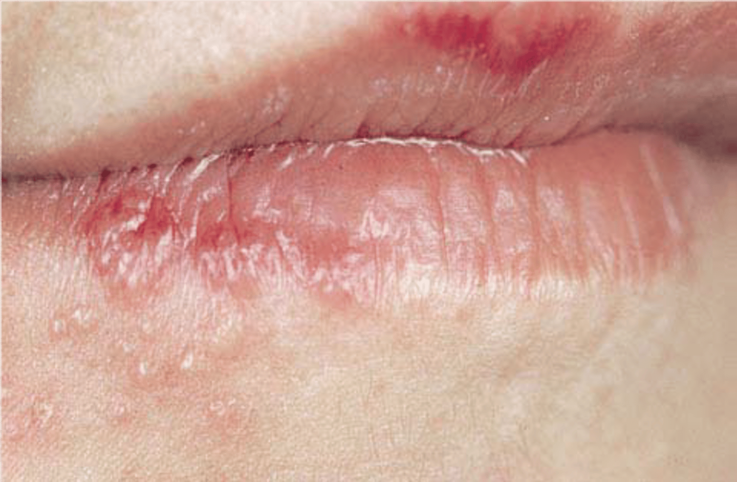 <p>-triggered by trauma</p><p>-keratinized mucosa</p><p>-extraoral reoccurences = herpes labialis</p><p>-intraoral reoccurences limited to keratinized mucosa</p><p>-antivirals kay shorten duration</p><p>-can give anti-viral (valtrex) before appt.</p>