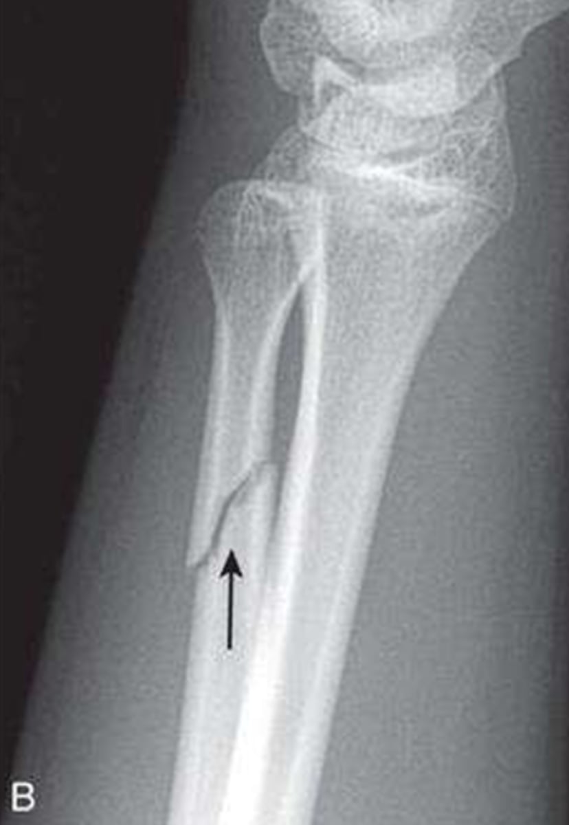 <p>What type of fracture is this?</p>