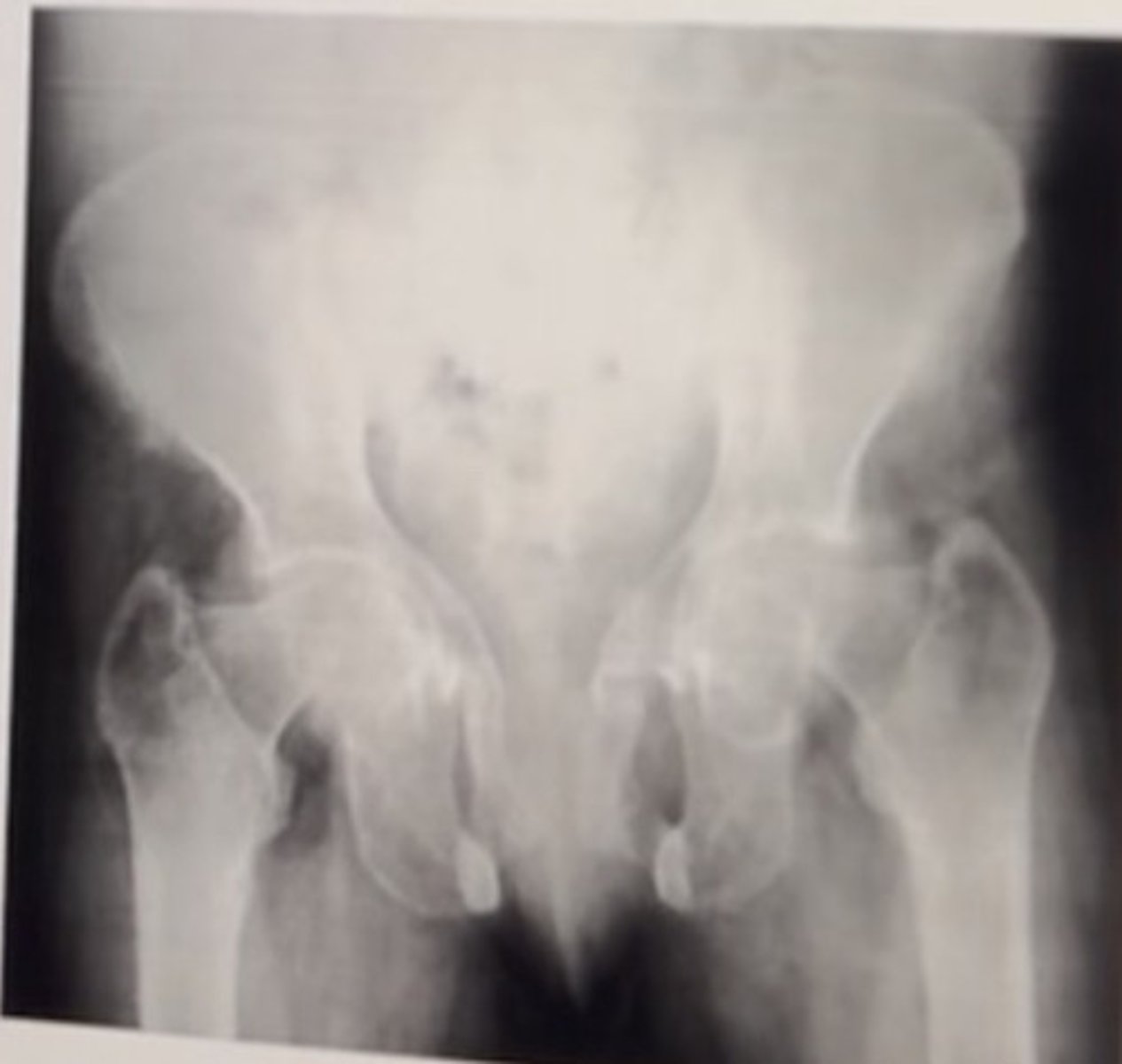 <p>Please choose two possible diagnoses:</p><p>Select 2 correct answers:</p><p>• Fibrous dysplasia</p><p>• Osteomalacia</p><p>• Secondary hyperparathyroldism</p><p>• Paget disease</p>