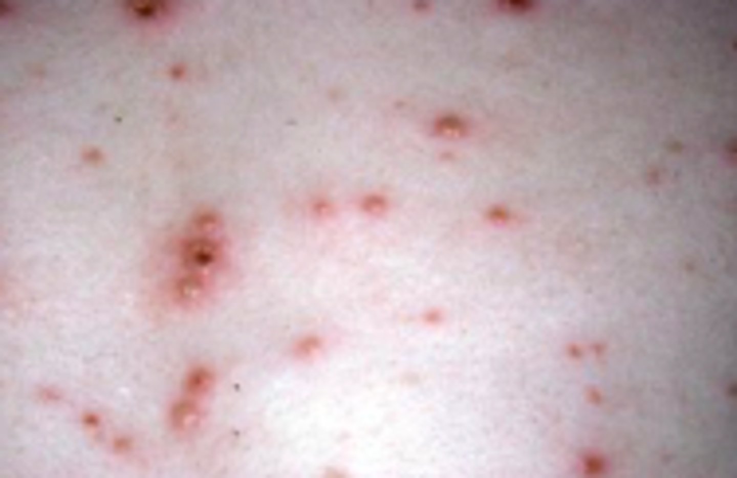 <p>Viral ID:</p><p>Overview:</p><p>1 of 8 herpes viruses known to cause human infection</p><p>- Causes 2 clinically distinct forms of disease: this (chickenpox) and herpes zoster (shingles)</p>