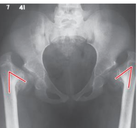 <p>-increased hip joint stability</p><p>-increases moment arm of abductors (functionally stronger hip) reduces joint reaction force</p><p>-increase bending moment across femoral neck predisposition for (slipped capital femoral epiphysis or femoral neck fracture) </p>