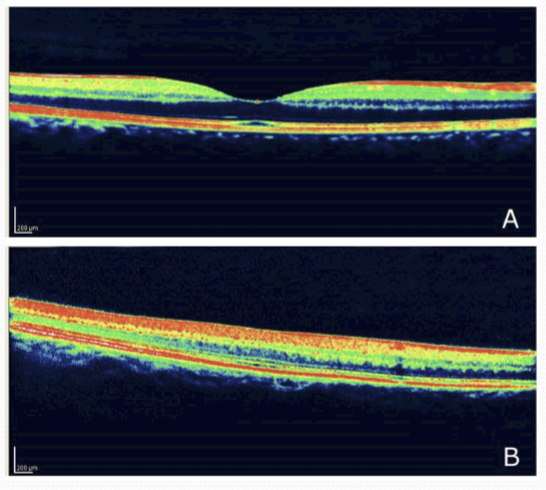<p>The fovea. It ranges in severity, reduced/variable cone density, reduced visual acuity, and delay in visual maturation. </p>