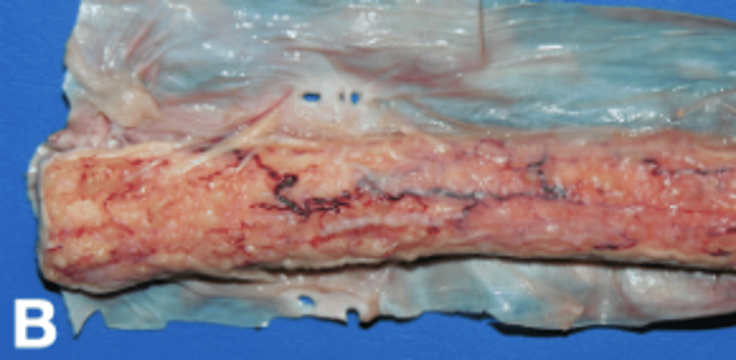 <p>- Granulomatous</p><p>- Pyogranulomatous</p><p>- Neoplasia</p><p>- Immunocompromised</p>