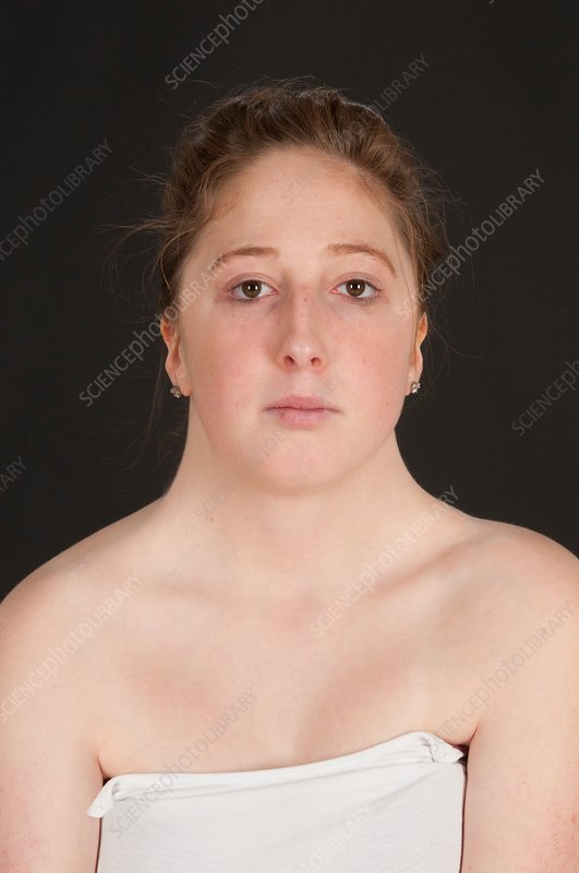 <p><strong>Females</strong>: <span style="color: rgb(240, 66, 192);"><span>only </span><strong><span>one functioning X </span></strong><span>chromosome</span><strong><span> (XO)</span></strong></span></p><ul><li><p><span style="color: rgb(242, 53, 53);"><strong><span>short </span></strong><span>stature</span></span></p></li><li><p><span style="color: rgb(119, 166, 37);"><strong><span>infertile</span></strong></span></p></li><li><p><span style="color: rgb(53, 144, 170);"><span>low hair line</span></span></p></li><li><p><span style="color: rgb(77, 48, 232);"><span>wide chest/neck</span></span></p></li><li><p><span style="color: rgb(248, 27, 193);"><strong><span>amenorrhea</span></strong></span></p></li></ul><p></p>