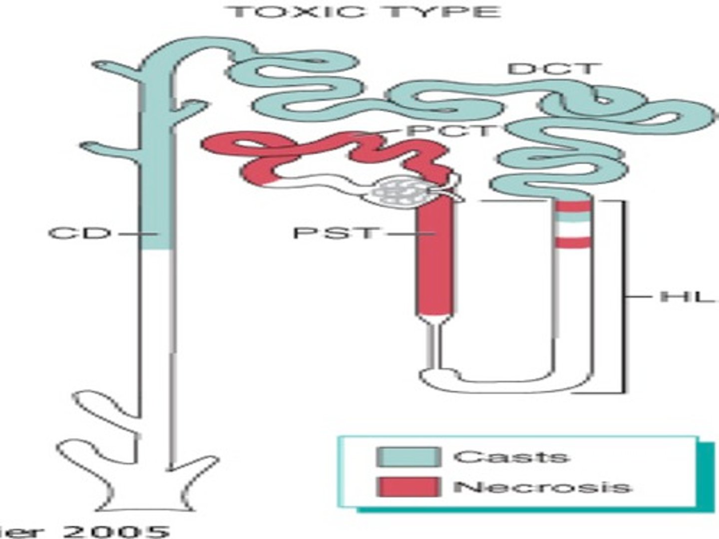 <p>a kidney disorder involving damage to the tubule cells of the kidneys, which can lead to acute kidney failure</p>