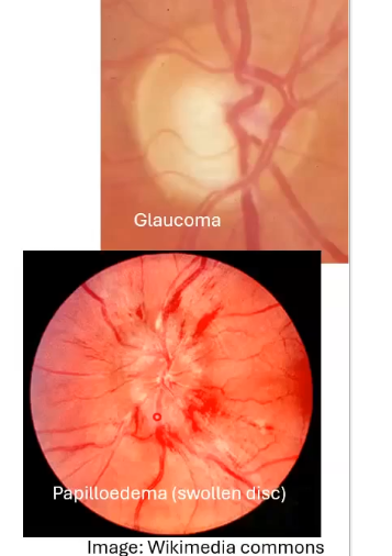 <p>why do we examine the onh </p>