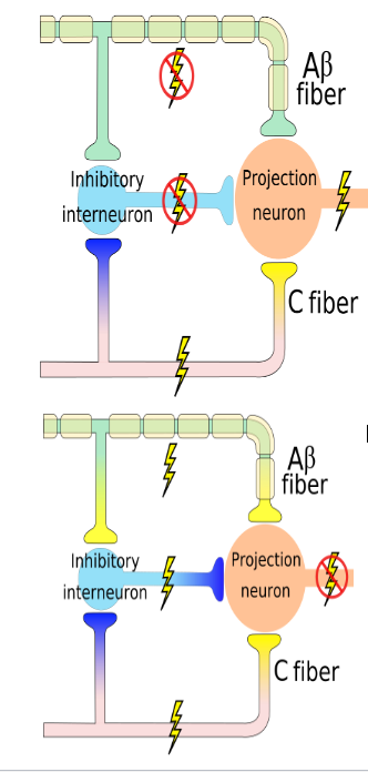 <p><span>Normally: stimulation of C fibers stimulates the projection neurons in the dorsal horn and thus sends the pain signals on to the brain (A)</span><br></p><p><span>Applying an electrical current to the area in pain does the following:</span></p><ul><li><p><span>Activation of the inhibitory interneurons and larger Aβ fibers → stops nocioceptive signals</span></p></li><li><p><span>Pressure (massage) can also do this by activating the large diameter Aβ fibers</span></p></li></ul><p></p>