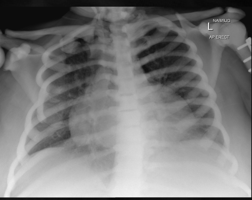 <p>what is seen here for this case of osteopetrosis?</p>