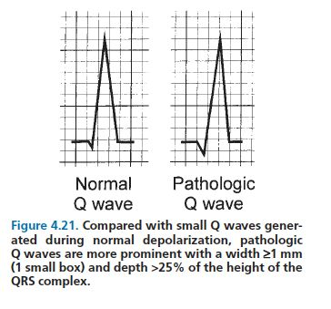 <p><strong>Duration &gt;40 ms, amplitude &gt;0.1 mV, or appearance in leads V1-V3,</strong> indicating myocardial necrosis.</p>