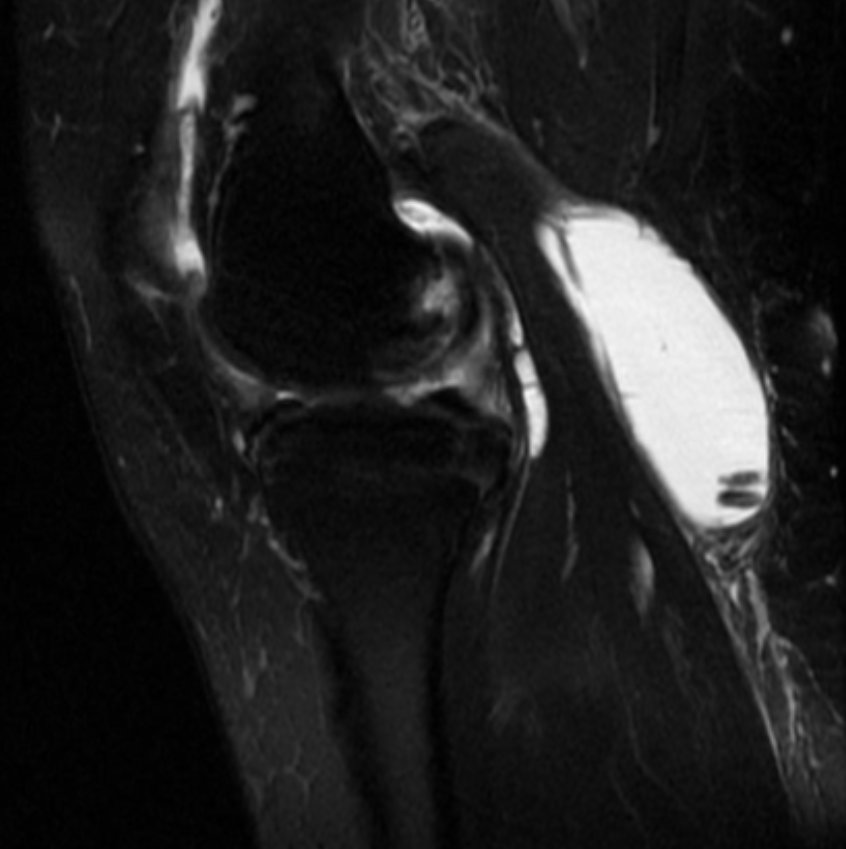 <p>Describe the pathology (Sag T2 FS). </p>