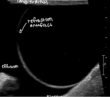 <p>refraction artifact at apex of bladder</p>