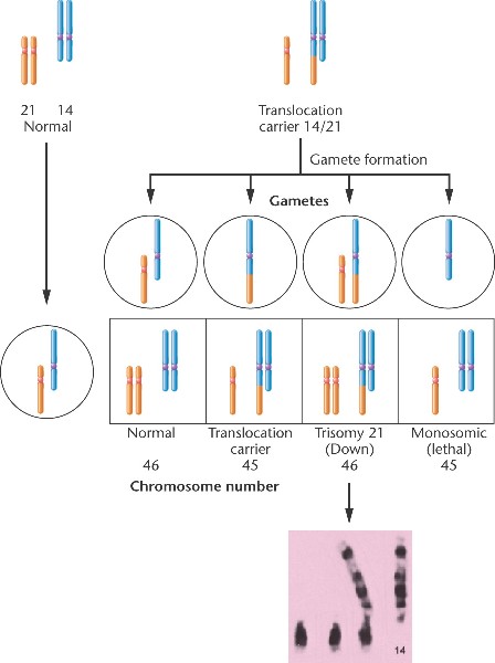 <p>caused by robertsonian translocation between 14 and 21…family passes down translocation…5% of down syndrome…</p>