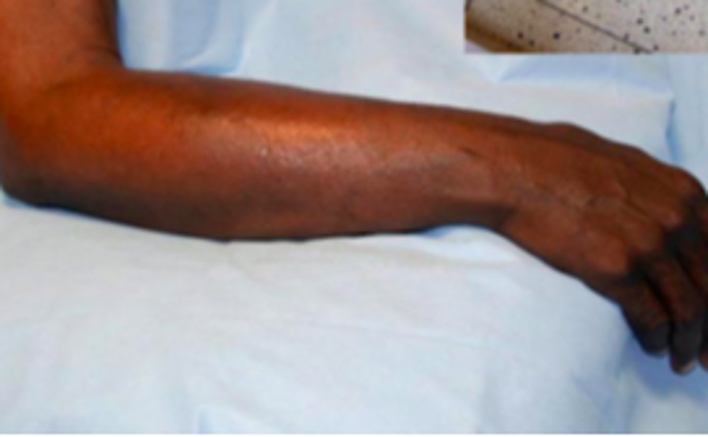 <p>Bacterial ID:</p><p>Objective:</p><p>- Areas of skin erythema, edema, and warmth</p><p>- Petechiae and/or hemorrhage can be seen</p><p>- Superficial bullae</p><p>- Nearly always unilateral</p><p>- Lower extremities are the most common site of involvement</p><p>- Lymphangitis - red streaking</p><p>- Regional lymphadenopathy</p><p>-Edema surrounding the hair follicles may lead to dimpling in the skin</p><p>- Fever and other systemic manifestations</p>
