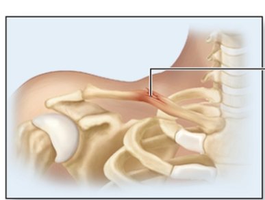 <p>What is a greenstick fracture?</p>