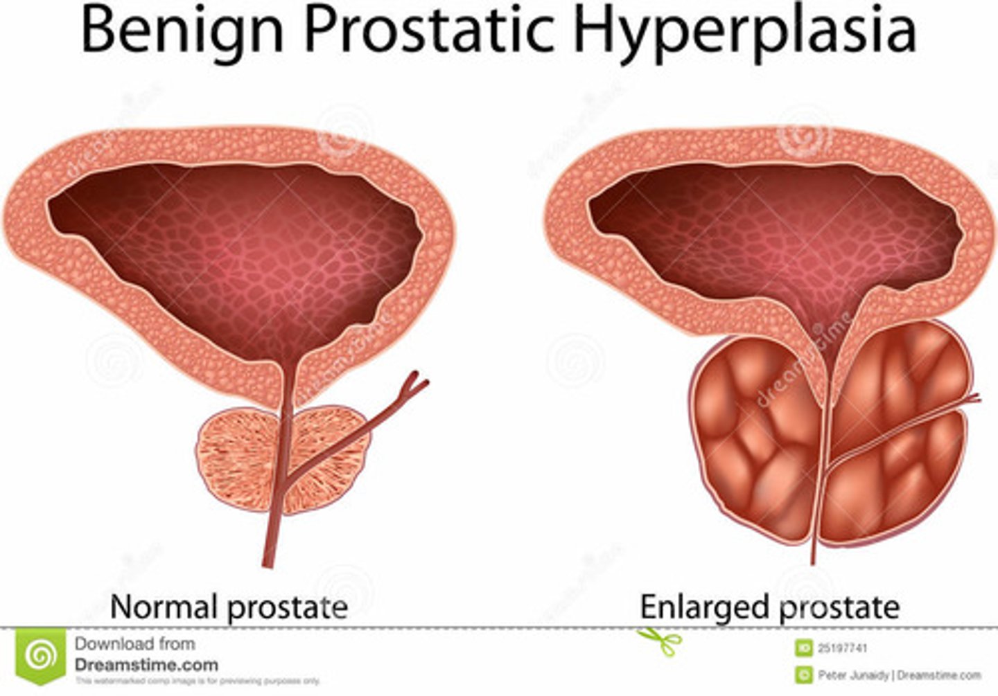 <p>enlarged prostate </p>
