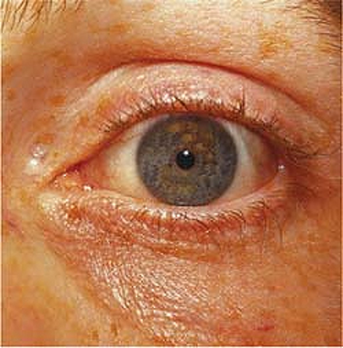<p>- miotic (pinpoint) pupils</p><p>- drooping eyelids</p><p>- scratching/pruritis (histamine release)</p><p>- depressed respiratory drive</p><p>- LOC</p>