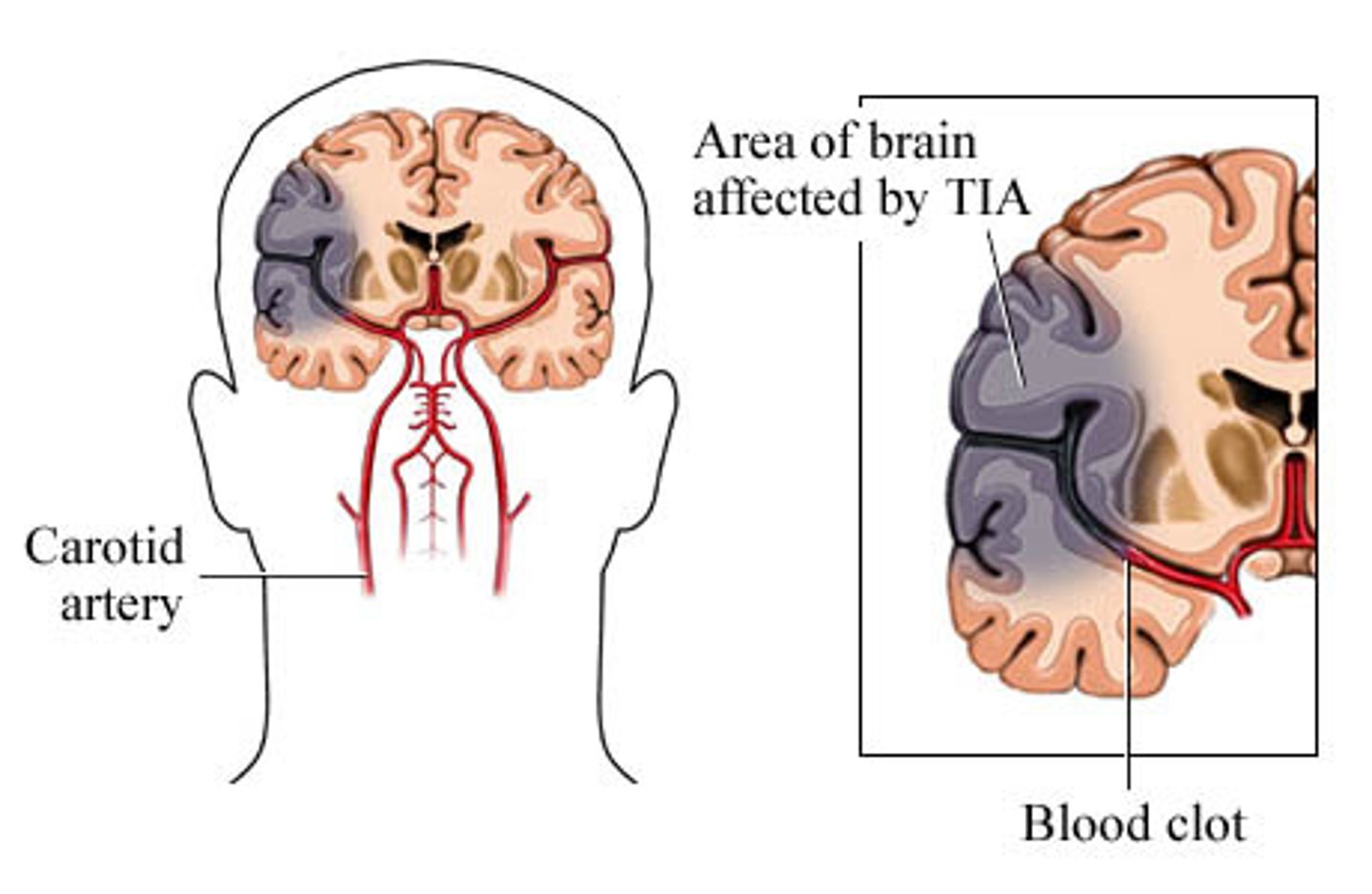 <p>When blood flow to a part of the brain stops for a brief period of time. A person will have stroke-like symptoms for up to 24 hours, but in most cases for 1 - 2 hours.</p>