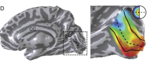 <p>Spreading out of optic radiations - only inferior and superior could be damaged, but then would see different pattern of visual impairment if the whole thing is damaged.</p>