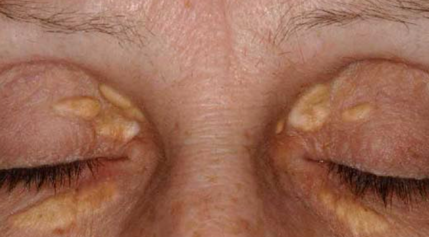 <p>what type of color change and condition is depicted</p>