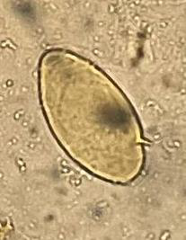 <p><strong>Identify the parasite (Genus, species, and stage).</strong></p><ul><li><p><em>Schistosoma mansoni</em> egg</p></li></ul><p><strong>Mention two characteristic features of this stage.</strong></p><ul><li><p>About 140 × 70 µm, colourless, contains mature miracidium</p></li><li><p>Thin shell with a lateral spine</p></li></ul><p><strong>Mention the direct methods used for diagnosing the neurological form of this disease.</strong></p><ul><li><p>Confirmation of schistosomal infection by a direct method</p></li><li><p>Histopathological examination of the nervous tissue</p></li></ul><p><strong>Specify CSF characteristics in case of neurological affection.</strong></p><ul><li><p>Increased total protein</p></li><li><p>Presence of eosinophils and antibodies</p></li></ul><p></p>