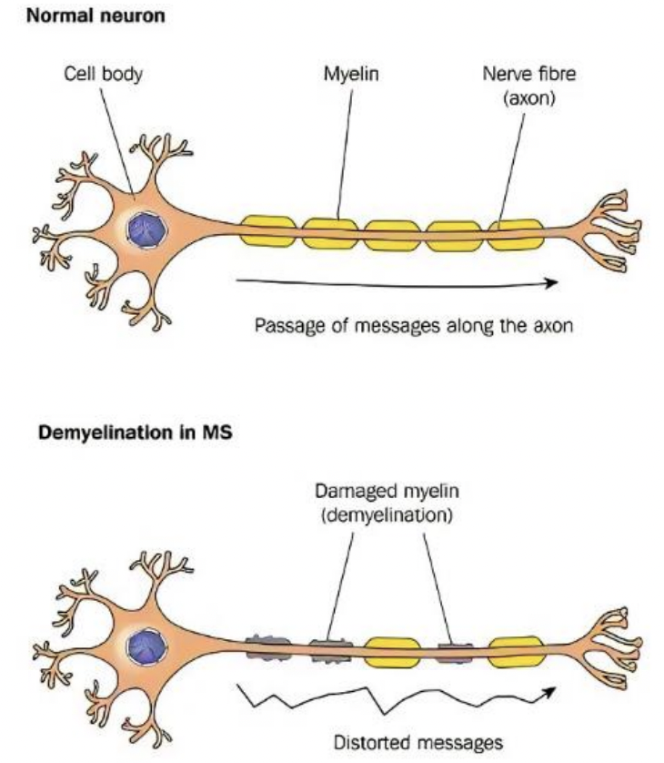 <ul><li><p>regional loss of myelin in CNS or PNS resulting in slowing or blockage of action potential </p></li><li><p>PNS</p><ul><li><p>guillian barre (acute inflammatory demyelinating polyneuropathy) </p></li></ul></li><li><p>CNS</p><ul><li><p>multiple sclerosis: demyelination plus formation of astrocytic scars (sclerotic plaques) </p></li></ul></li></ul><p></p>
