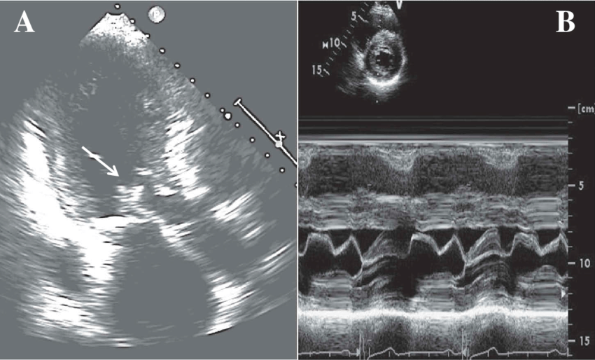 <p>What is seen in this 2D image?</p><p>What condition is it seen in?</p>