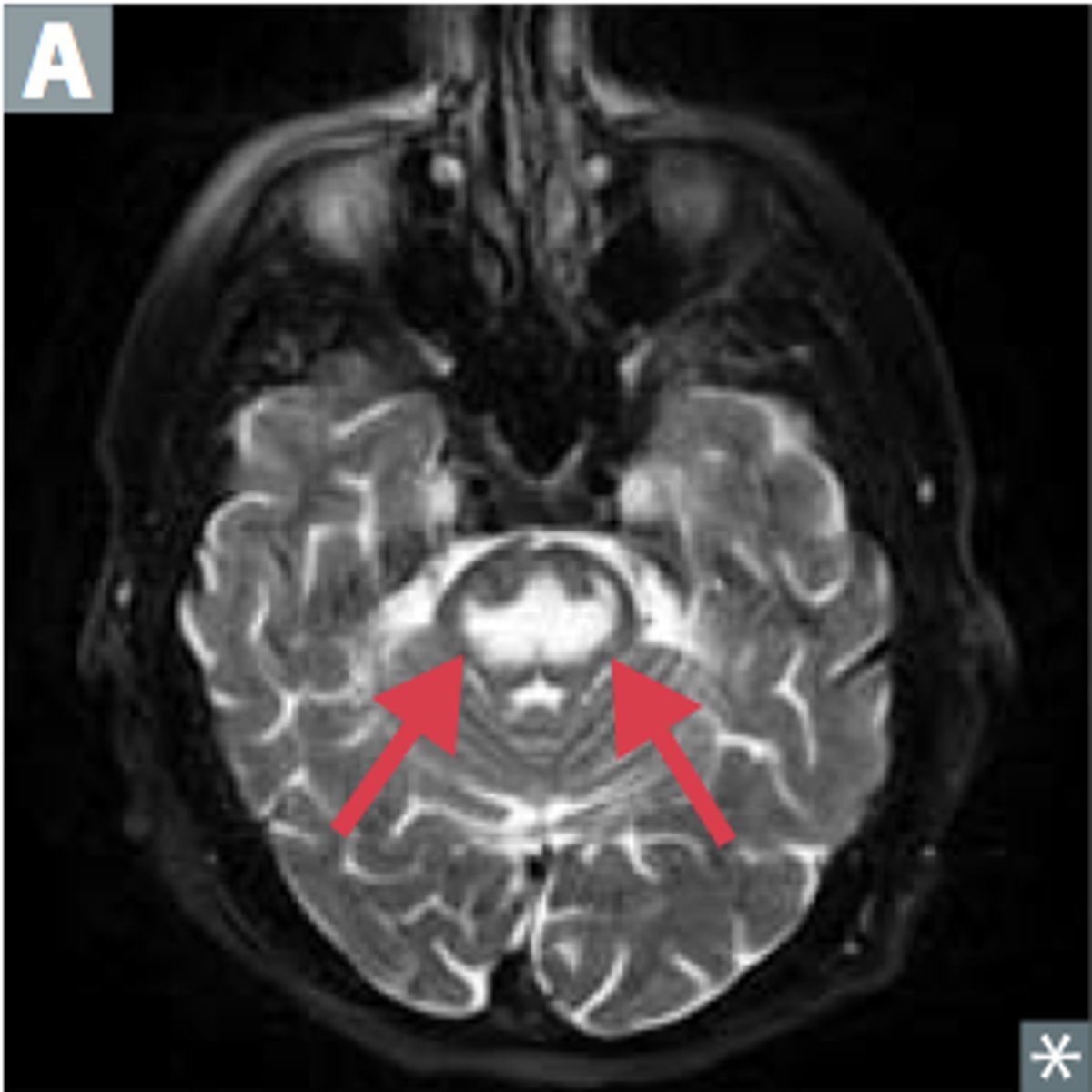 <p>Neurological damage to brain stem occurs if sodium levels rise to quickly</p><p>• Often result of hyponatremia</p>