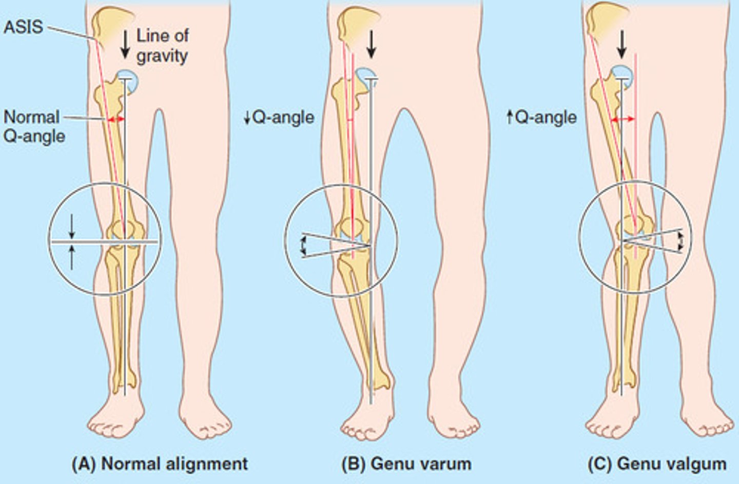 <p>varum = bowlegs</p><p>valgus = knock knees</p><p>resolve on their own***</p>