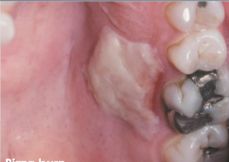 <p>due to contact with hot food/beverage </p>