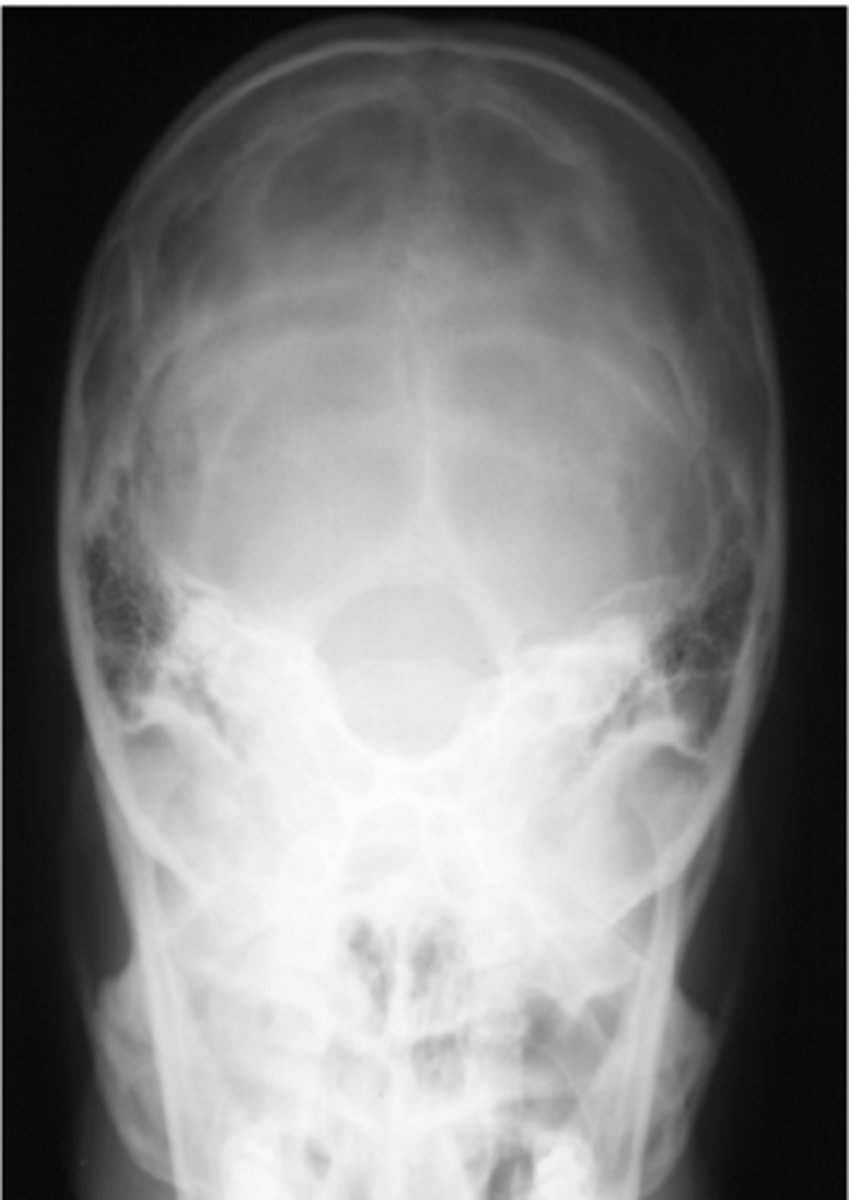 <p>Repeatable errors (three)—</p><p>Criterion 3: Collimation and CR: CR is overangled.* The anterior arch of C1 (rather than the dorsum sellae) is projected into the foramen magnum. </p><p>Criterion 4: Exposure: Mid/lower aspect of skull underexposed (analogy). </p><p>Criterion 5: Anatomic side markers: There is no evidence of side marker.</p>