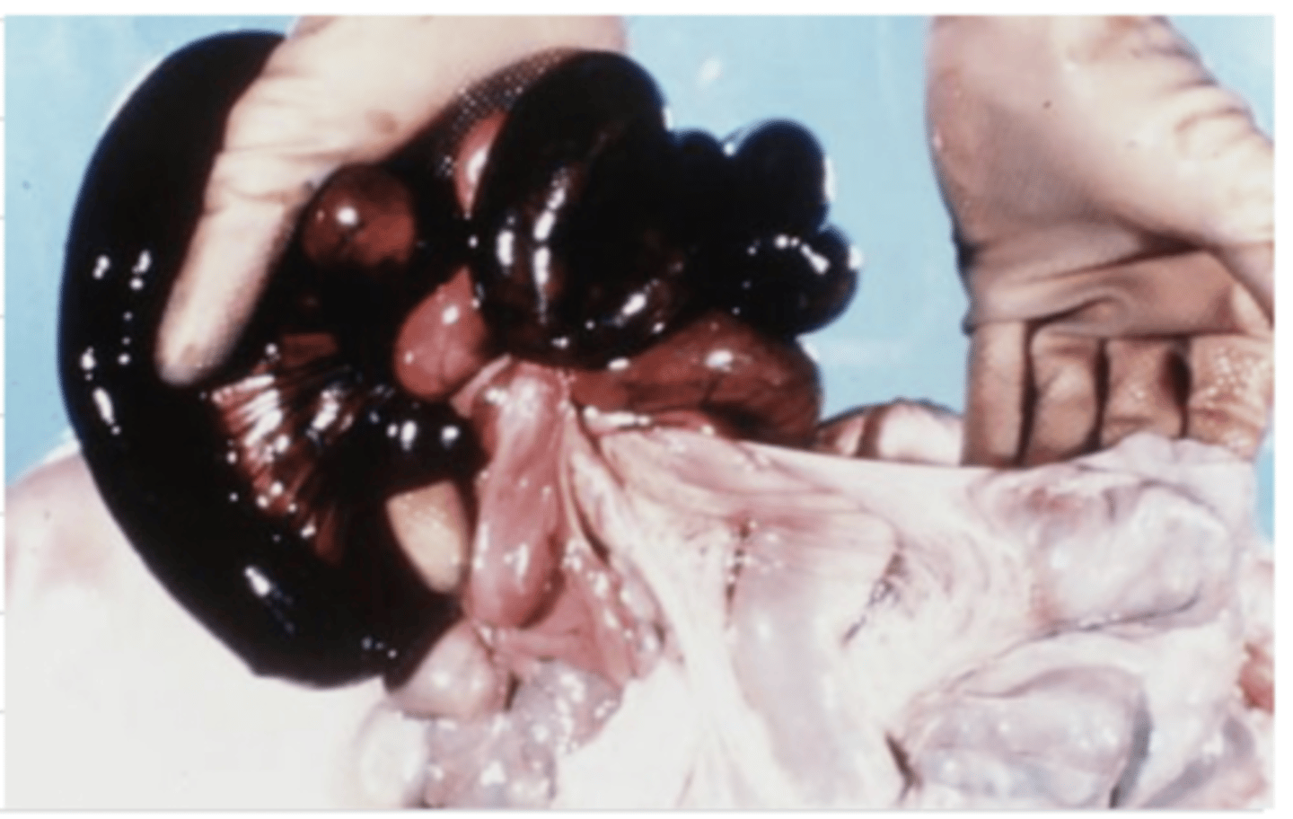 <p>acute passive local congestion due to torsion</p>