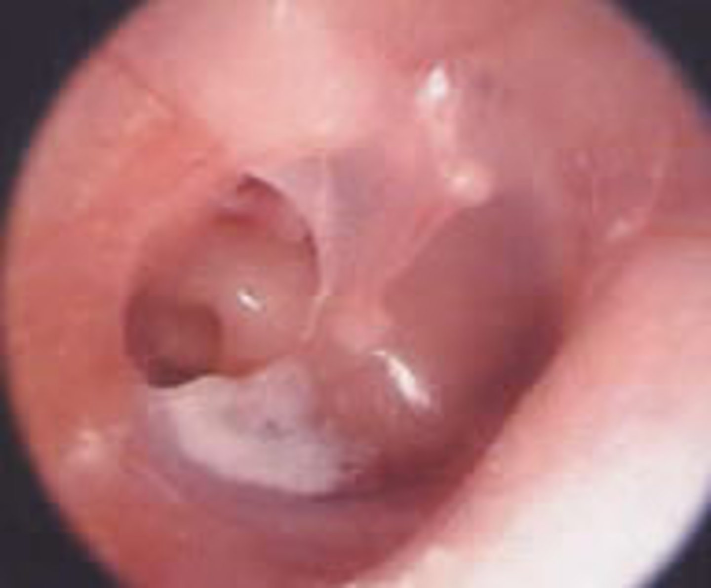 <p>dx: tympanic membrane perforation</p><p>tx: observation (most heal spontaneously) but can do surgical repair; avoid water/moisture/topical aminoglycoside (ototoxic) in ear</p>