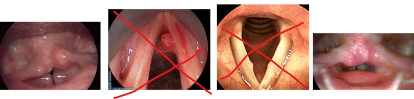 <p>Muscle tension dysphonia lateral compression (coming in from sides)</p><p>Muscle tension dysphonia anterior-posterior compression (top to bottom squeeze)</p>