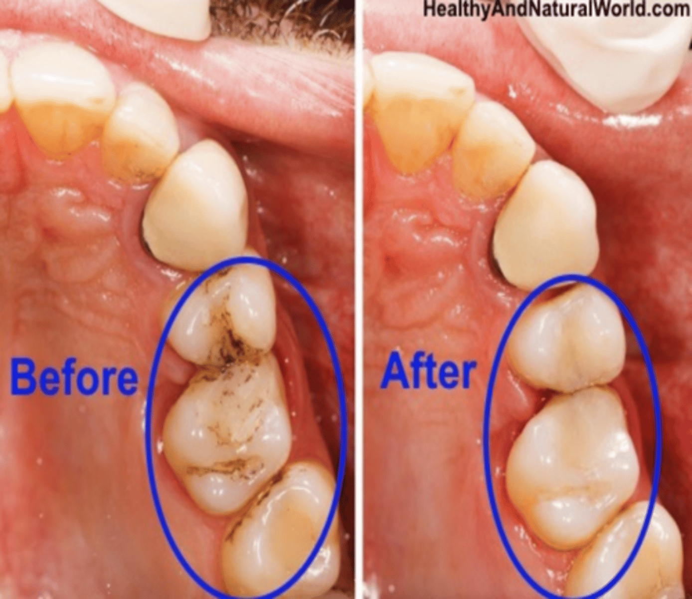 <p>ancient Indian folk remedy for bleeding gums</p><p>• sunflower, sesame, palm, coconut, or olive oil is swished back and forth for 10-20 minutes</p>