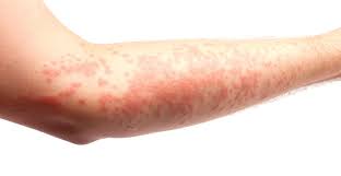 <p>What is a reactive erythema?</p>