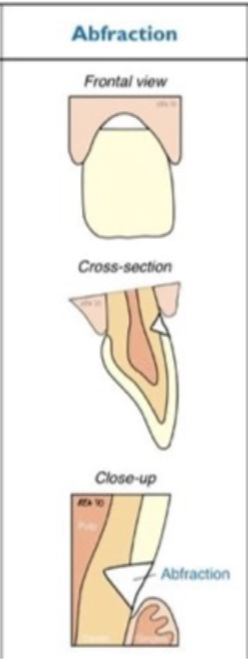 <p>single tooth- often upper premolars first </p>