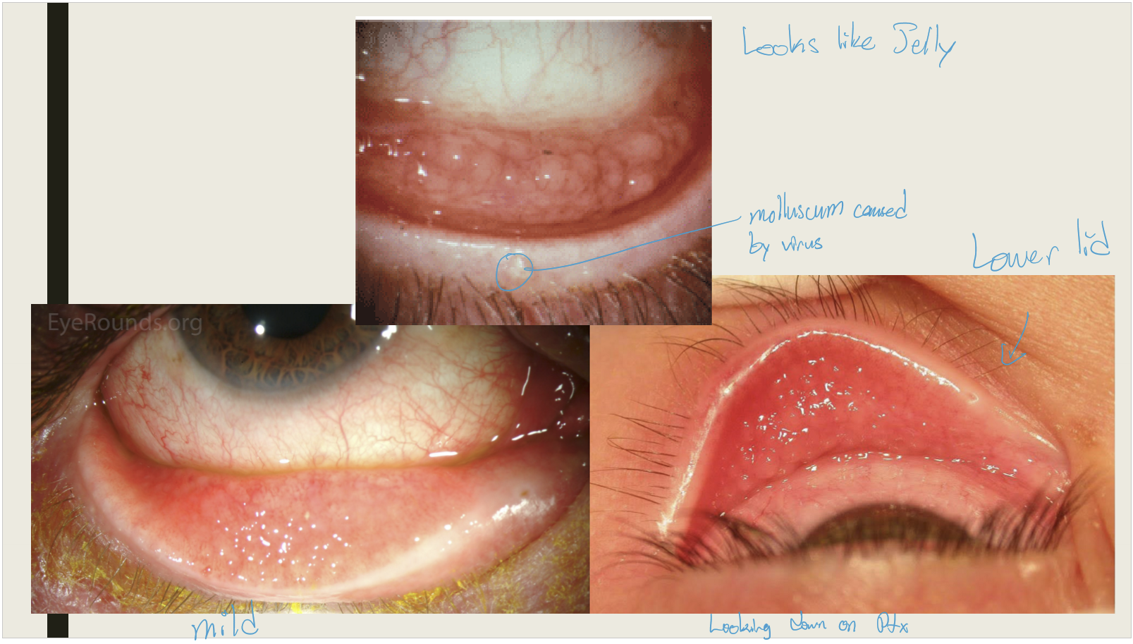 <ul><li><p>Viral infections</p></li><li><p>Chlamydial infections</p></li><li><p>Parinaud oculoglandular syndrome</p></li><li><p>Hypersensitivity to topical medications</p></li></ul><p></p>